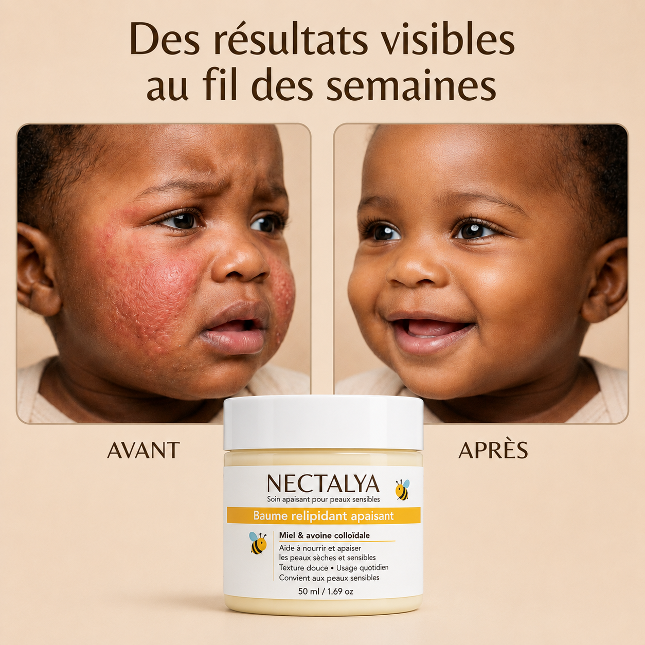 Crème au miel Nectalya pour l'eczéma