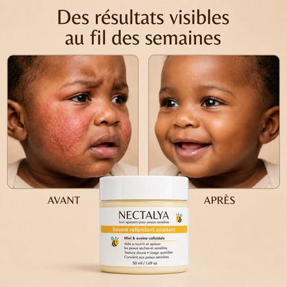 Crème au miel Nectalya pour l'eczéma