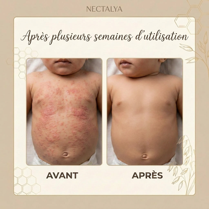 Crème au miel Nectalya pour l'eczéma (toute ethnie)