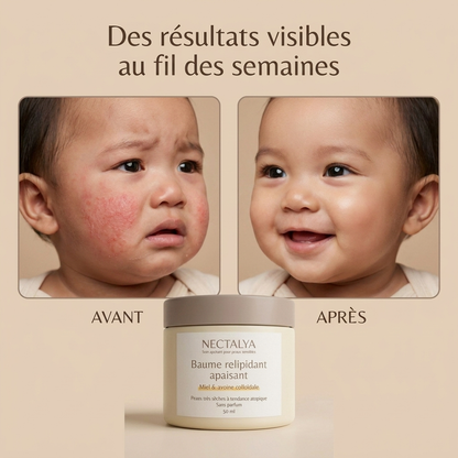 Crème au miel Nectalya pour l'eczéma (toute ethnie)